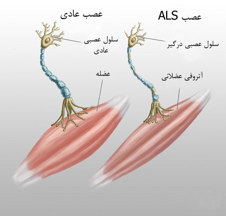 بیماری ای ال اس (ALS) علت، علائم و درمان