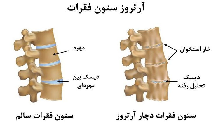 درمان آرتروز ستون فقرات