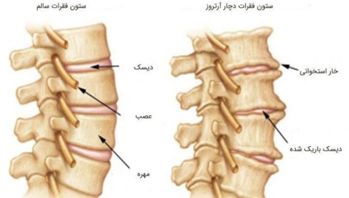 درمان خانگی آرتروز کمر