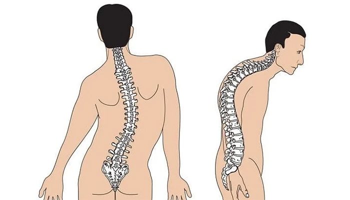 حالت طبیعی ستون فقرات