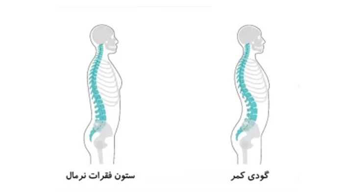 بهترین روش خوابیدن برای گودی کمر