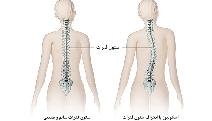 انحراف ستون فقرات و نحوه درمان