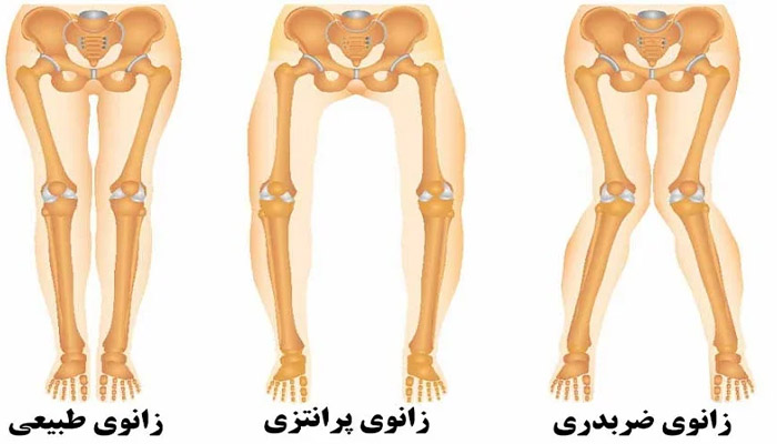 روش های درمان زانوی ضربدری