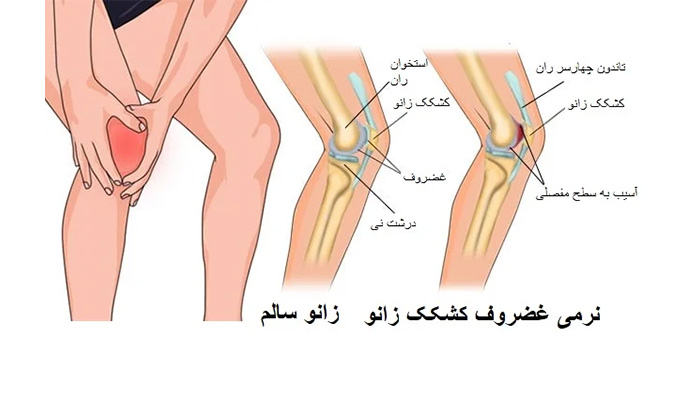 ورزش برای درمان نرمی غضروف زانو