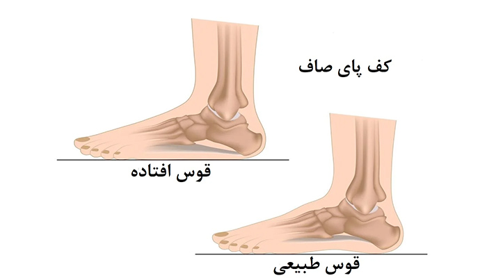 صافی کف پا تا چه سنی قابل درمان است