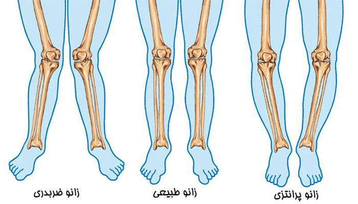 دکتر زانو ضربدری و پرانتزی