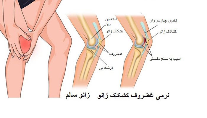 درمان قطعی نرمی کشکک زانو