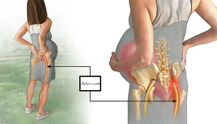 انواع روش‌ های درمان درد سیاتیک در بارداری